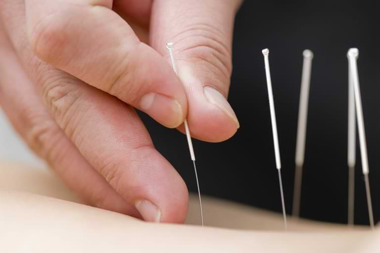 Acupuncture